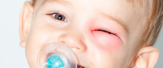 Your Guide to First Aid for Wasp, Bee, or Bumblebee Stings